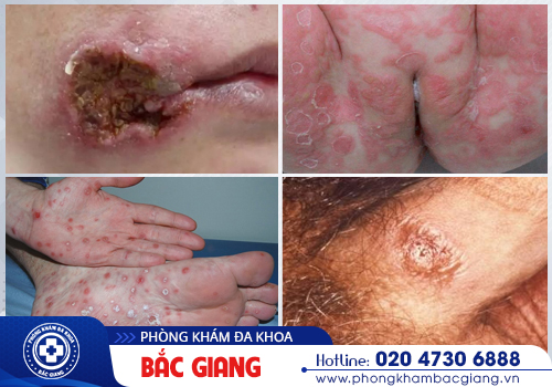 Hình ảnh nhận biết sớm bệnh xã hội, kịp thời hỗ trợ điều trị hiệu quả