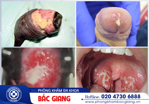 Các bệnh xã hội thường gặp và nguy hiểm hiện nay