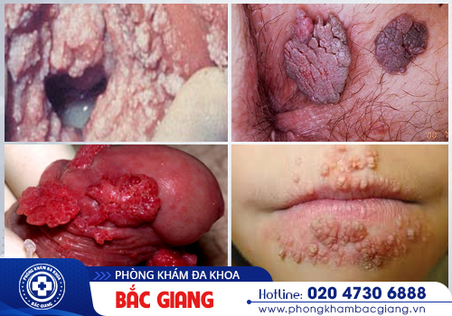 Đốt sùi mào gà và những điều cần biết khi điều trị