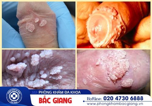 Virus HPV - Nguyên nhân gây ra nhiều bệnh lý ung thư nguy hiểm ở nam và nữ