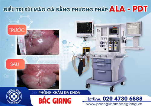 Sùi mào gà nam - Dấu hiệu nhận biết sớm và biện pháp điều trị