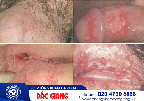 Âm đạo nổi mụn rộp không đơn thuần là do vấn đề vệ sinh