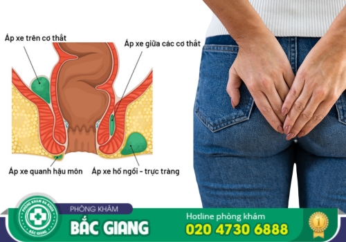 địa chỉ chữa ap xe hậu môn tại bắc giang