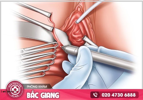 Bảng giá dịch vụ thu hẹp âm đạo ở Bắc Giang năm 2024