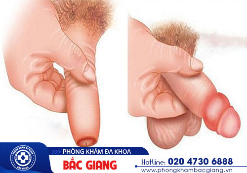Bao quy đầu là gì? Các bệnh thường gặp ở bao quy đầu?