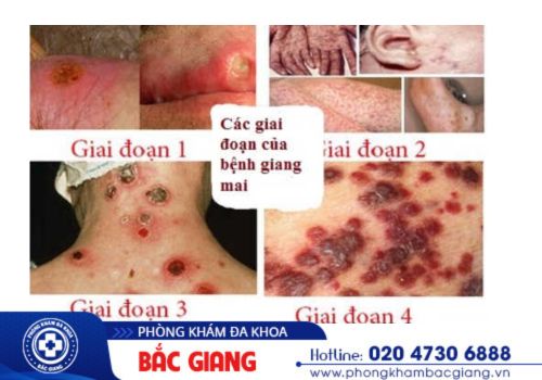 giang mai có chữa được không