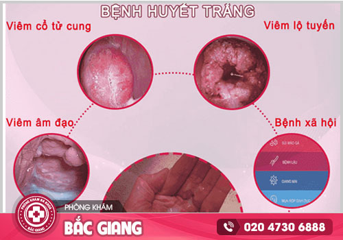 Tìm hiểu về bệnh huyết trắng và cách xử lý