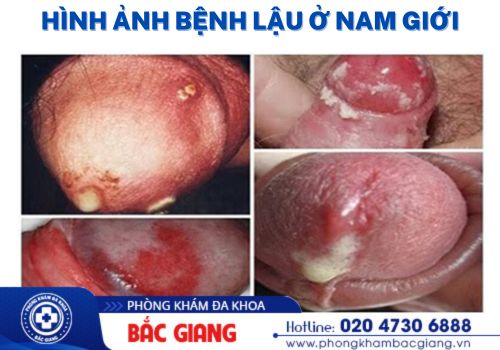 dương vật chảy dịch có sao không