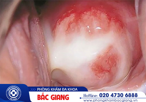 Bệnh lậu: Nguyên nhân, Triệu chứng và Cách điều trị