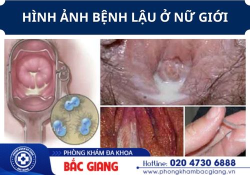 vùng kín bị chảy mủ là bị gì