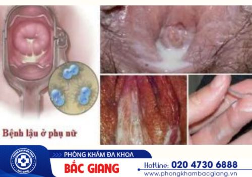 chảy mủ âm đạo