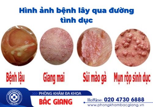 các bệnh lây qua đường tình dục