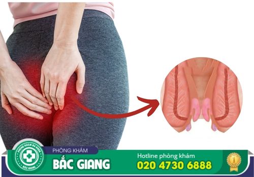 chữa bệnh trĩ ngoại ở bắc giang