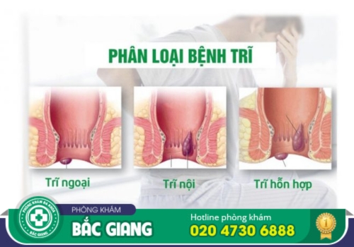 bệnh trĩ tổng hợp, nội, ngoại