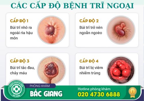 chi phí điều trị bệnh trĩ ngoại ở bắc giang