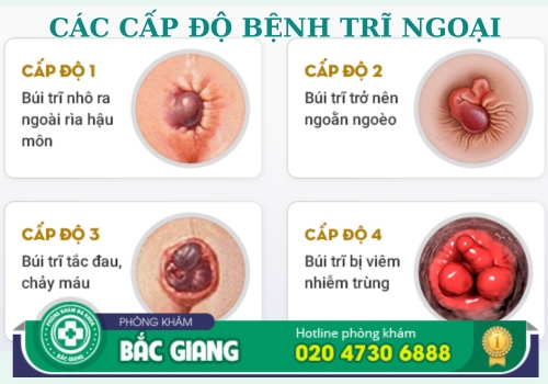 bệnh trĩ tổng hợp, nội, ngoại