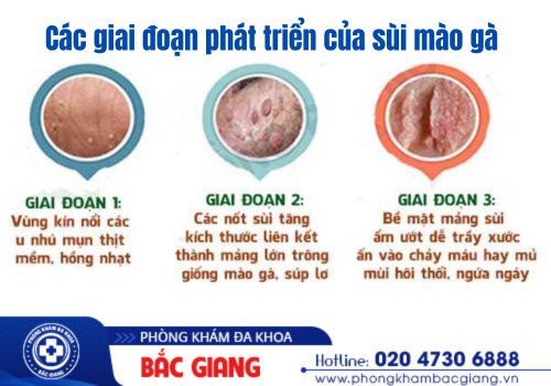 các giai đoạn sùi mào gà