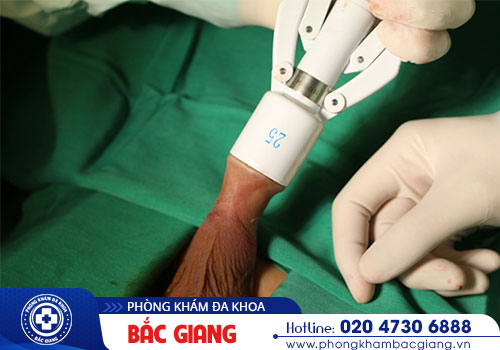 Cắt bao quy đầu là gì? Có nên cắt bao quy đầu không?