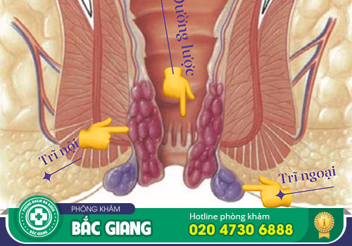 Cắt da thừa hậu môn là gì? Có đau không?