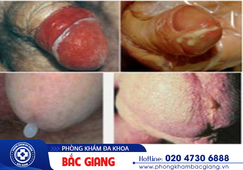 Chảy mủ dương vật - Dấu hiệu bất thường nam giới không thể chủ quan