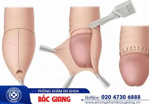 Chi phí cắt bao quy đầu hiện nay là bao nhiêu?