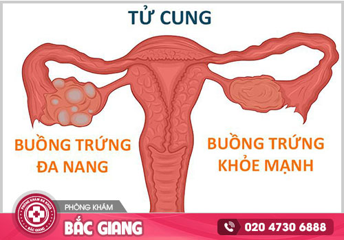 Chi phí chữa bệnh buồng trứng đa nang ở Bắc Giang là bao nhiêu?