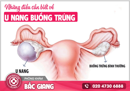 Chi phí chữa u nang buồng trứng ở Bắc Giang – Nữ giới phải trả bao nhiêu tiền?