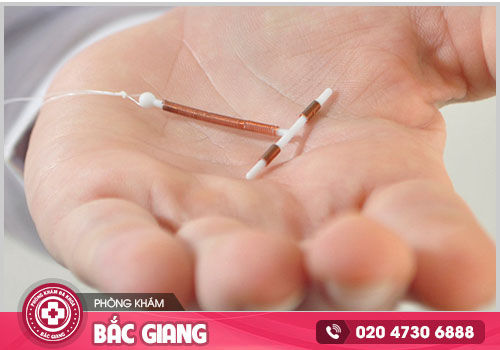 Chi phí đặt vòng tránh thai ở Bắc Giang là bao nhiêu năm 2024?