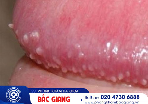 Chi phí điều trị hạt ngọc dương vật hiện nay là bao nhiêu?