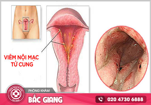 Nơi chữa viêm nội mạc tử cung tại Bắc Giang, điều trị kịp thời, tránh biến chứng