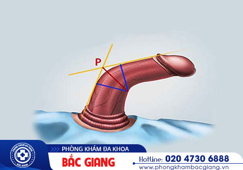 Chỉnh hình dương vật ở đâu an toàn, hiệu quả?