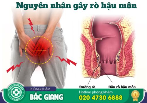 chữa bệnh rò rỉ hậu môn ở bắc giang