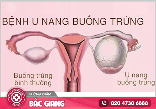 Những tiêu chí cần quan tâm khi lựa chọn địa chỉ chữa u nang buồng trứng tại Bắc Giang