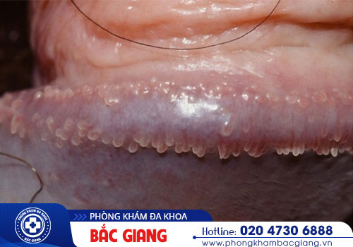 Có nên tự dùng thuốc trị hạt ngọc dương vật tại nhà hay không?