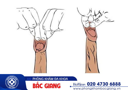 Dài bao quy đầu có sao không?