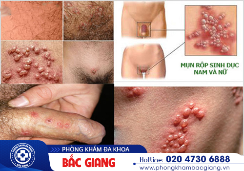 Nổi mụn rộp vùng kín có sao không?