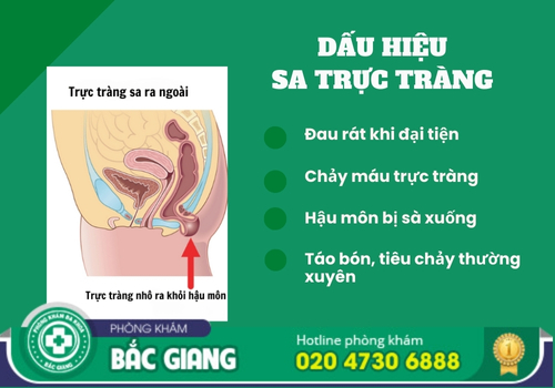 điều trị bệnh sa trực tràng tại bắc giang