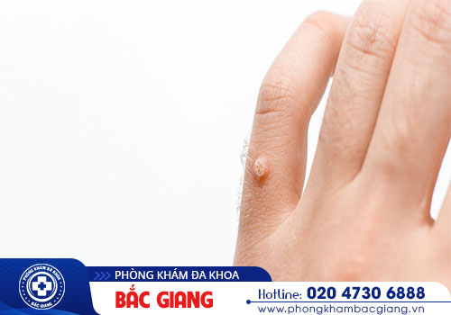 Đâu là dấu hiệu nhận biết sùi mào gà?