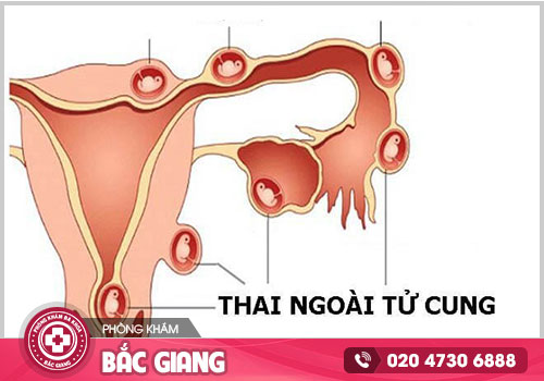 Đâu là nơi chữa viêm vùng chậu tại Bắc Giang chất lượng, đáng tin cậy?