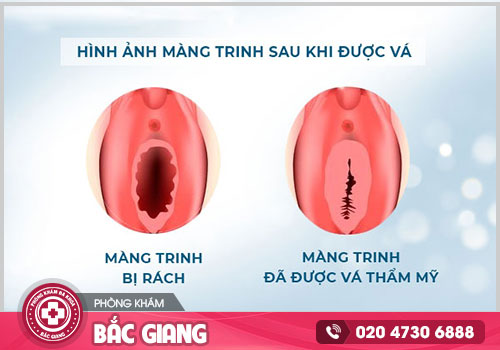 Đâu là nơi vá màng trinh an toàn ở Bắc Giang?
