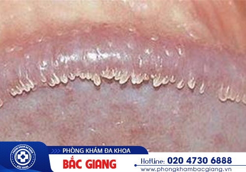 Đâu là phương pháp điều trị hạt ngọc dương vật hiệu quả?