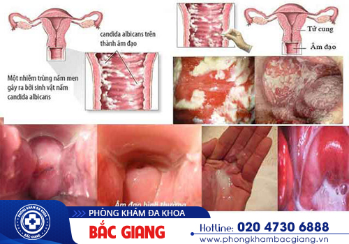 Đi vệ sinh bị rát sau khi quan hệ là bệnh gì?