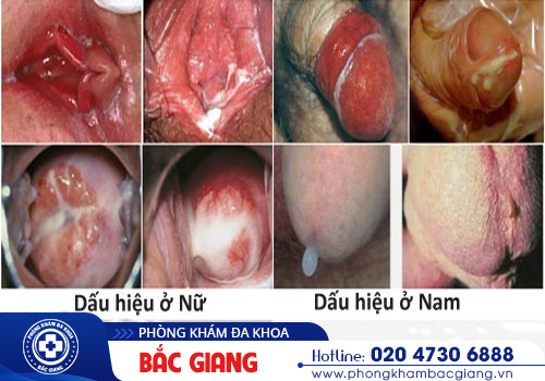 Giải đáp - Đi vệ sinh có mủ có phải bị bệnh lậu?