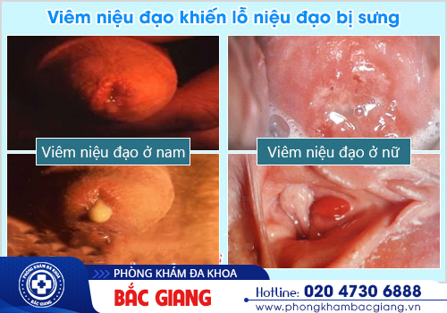 Tiểu ra mủ là bệnh gì? Nguyên nhân đến từ đâu?