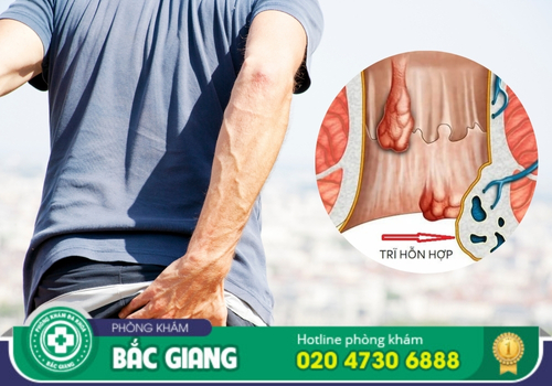 địa chỉ chữa bệnh trĩ hỗn hợp tại bắc giang