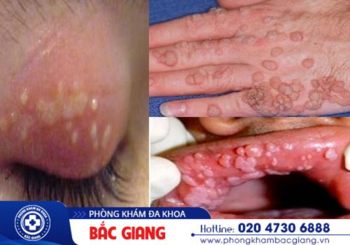 địa chỉ khám hpv