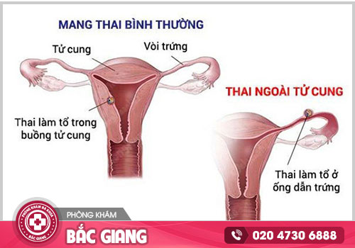 Địa chỉ khám và điều trị viêm vùng chậu tại Bắc Giang an toàn, hiệu quả