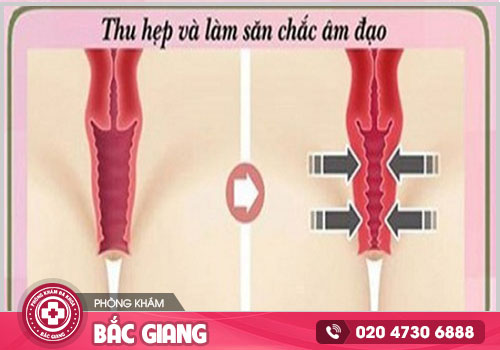 Địa chỉ thu hẹp âm đạo tại Bắc Giang nào an toàn thẩm mỹ?