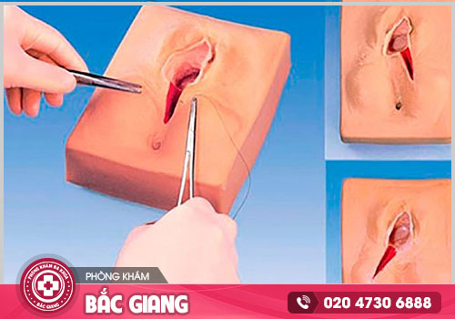 Dịch vụ vá màng trinh tại Bắc Giang ở đâu chất lượng, an toàn?