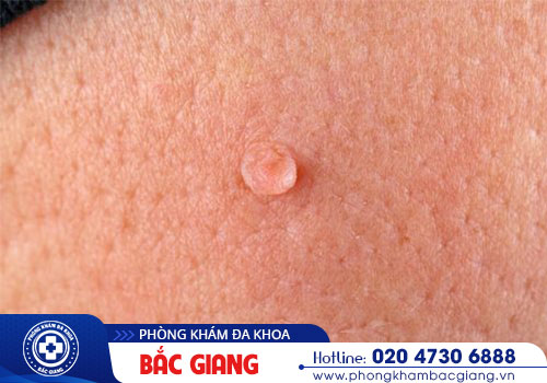 Điểm danh các biển hiện ban đầu sùi mào gà ở nam giới